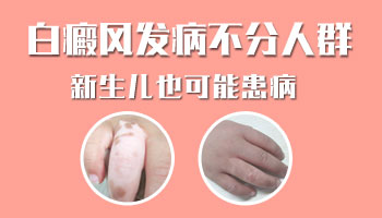 白癜风有什么症状 白斑一般发生在多大小孩身上