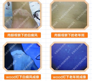 近发现腋下皮肤有块白斑