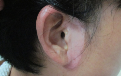 耳朵旁边淡白色斑点有点明显是什么病