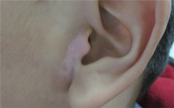 白斑在耳朵下面有点痒怎么回事
