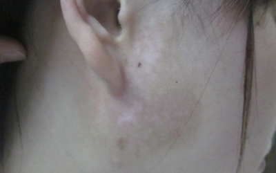 耳朵旁边靠近脸的位置有一块皮肤发白