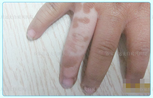 手背白斑初期症状图片