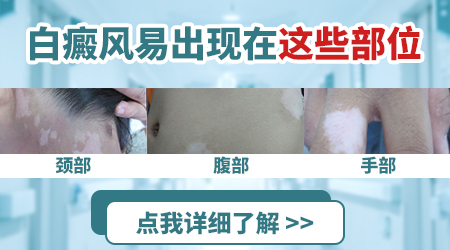 白斑初期容易长在哪里