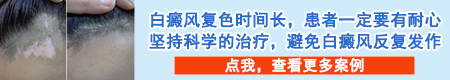 头皮白癜风治疗一段时间缩小了但是其他地方长白斑