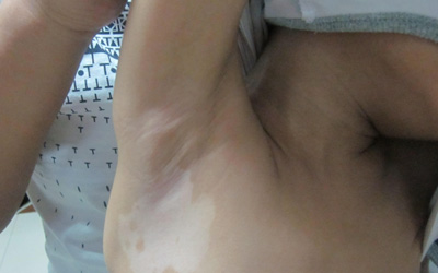 腋下早期白斑的症状 早期白癜风表现