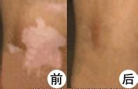 白癜风治疗做植皮手术有没有副作用?