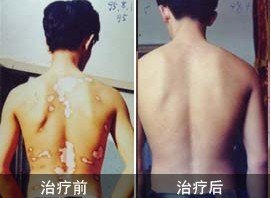 身上出现了大片的白斑能治的好吗