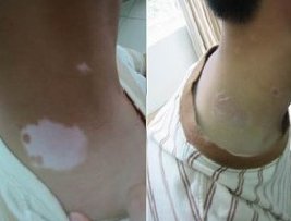 青少年白癜风怎么治疗省时间