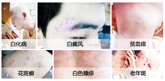白癜风治疗费用要多少