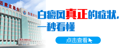 白癜风症状冗杂重复如何是好