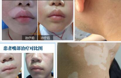 青少年得白癜风是什么样子的