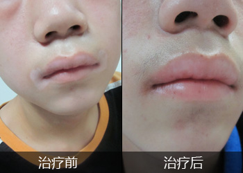 脸上白癜风早期有哪些症状