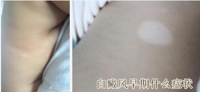 婴儿白癜风早期症状是什么