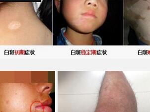 儿童白癜风有哪些早期症状