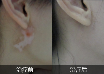 白癜风这种病有什么特性吗