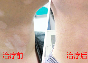 白癜风的比拟初症状有哪些