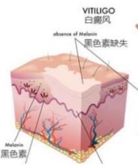 眼睛左近的白癜风能用308治疗吗