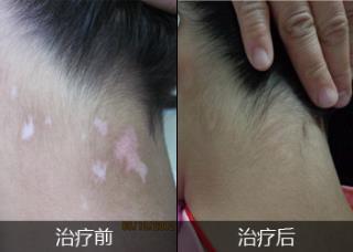 308激光治疗白癜风能治好么