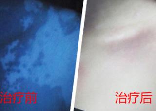 白癜风照308激光治疗仪多久照一次