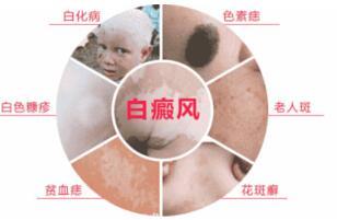 美国308适宜开展期的白癜风吗