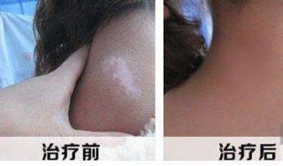 308光治疗一次白癜风就无效果吗