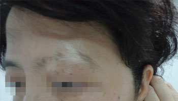 白癜风抹药治疗效果怎么样