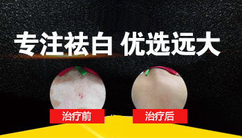 隐性白癜风不治疗行不行