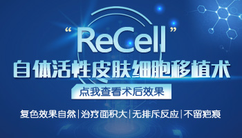recell自体活性细胞再生术治白癜风怎么样