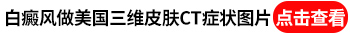 伍德氏灯下白斑是瓷白色还能治好吗