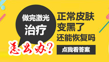白癜风308照光变黑会不会是剂量太大