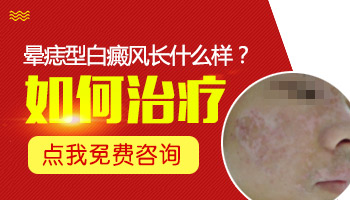 308激光治疗晕痣型白斑效果怎么样