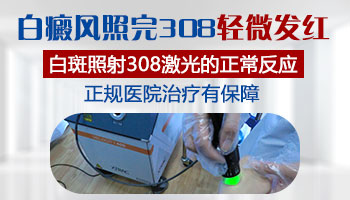 照完308激光三天后白癜风还发红