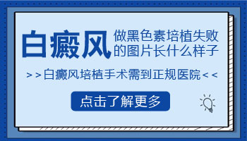 白癜风做了培植一个月没恢复好