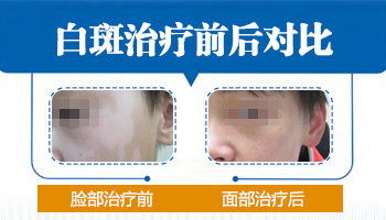 激光祛白斑几天做一次