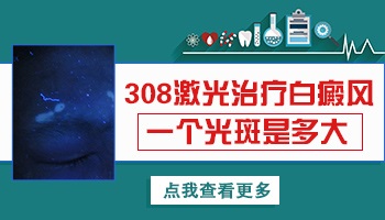 激光照白癜风一个光斑有多大面积