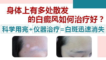 散发型白癜风怎么治能快点好