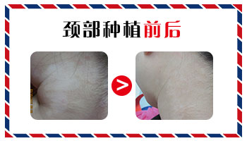 白癜风移植3个月了没看到效果