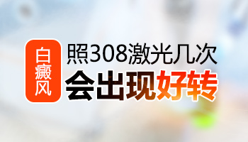 白癜风照308激光一个疗程后需要停止吗