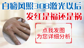照光后白癜风发红是正常的吗