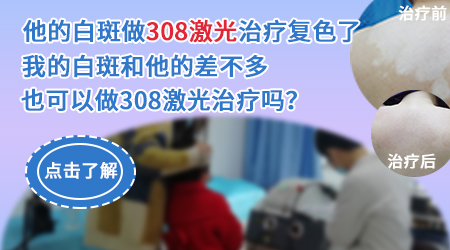 308激光治疗仪照白癜风有效吗