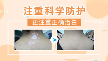 白癜风能不能根治 白癜风怎样算根治
