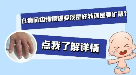 激光照射之后白癜风白斑变淡了