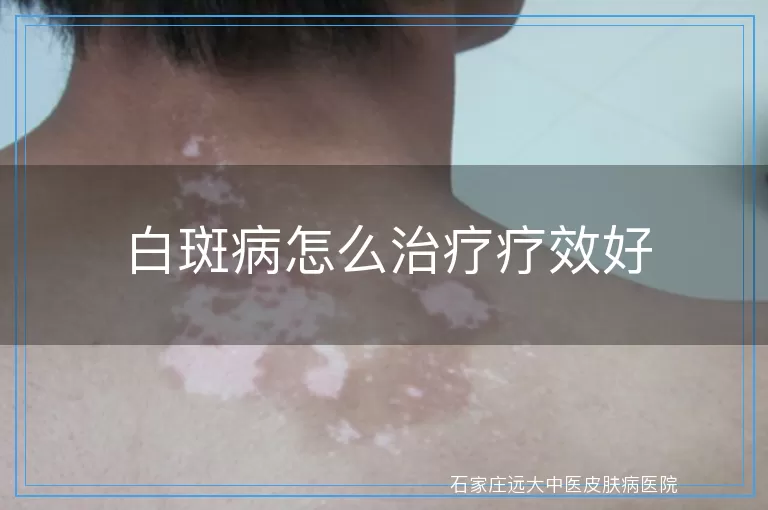 白斑病怎么治疗疗效好