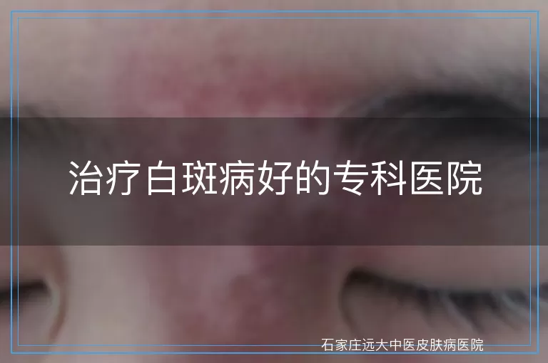 治疗白斑病好的专科医院