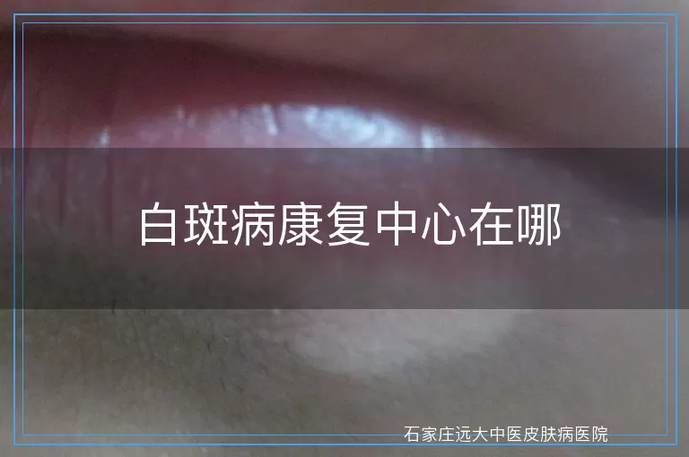 白斑病康复中心在哪