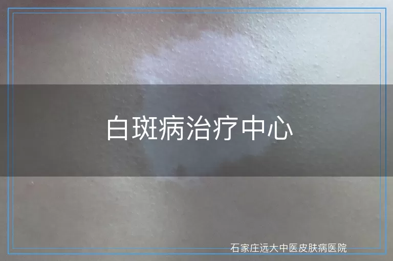 白斑病治疗中心