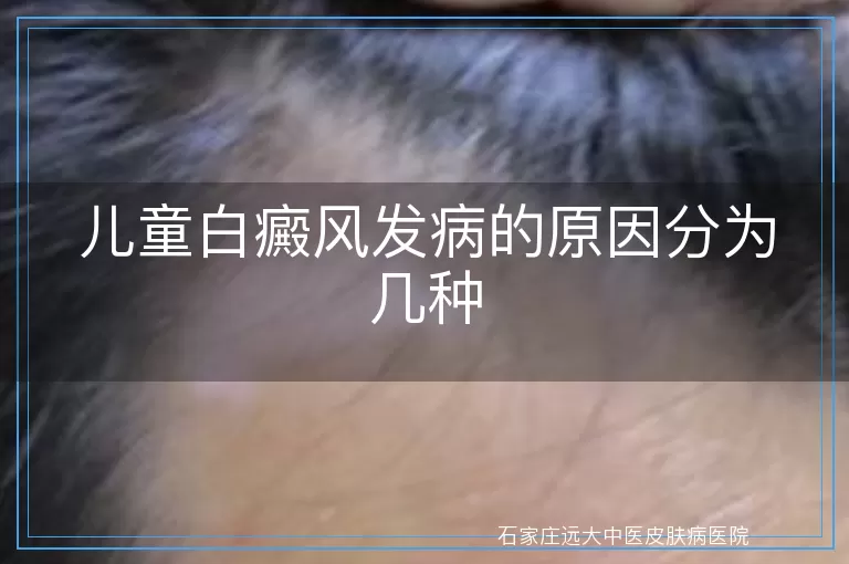 儿童白癜风发病的原因分为几种