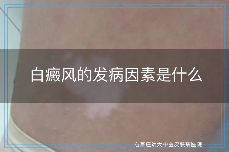 白癜风的发病因素是什么