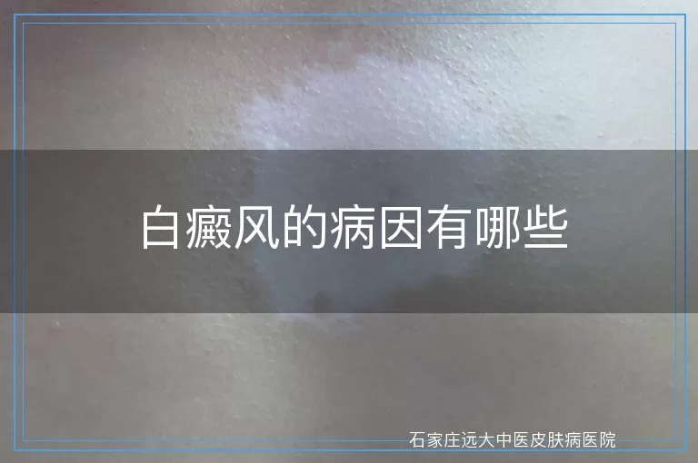 白癜风的病因有哪些