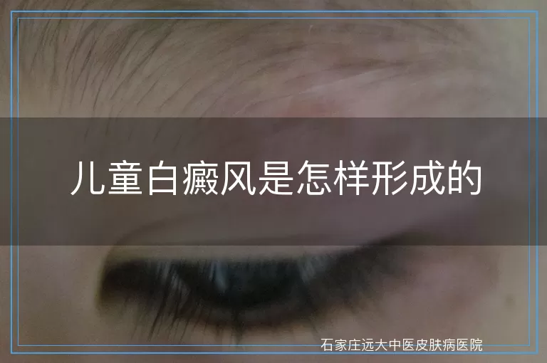 儿童白癜风是怎样形成的